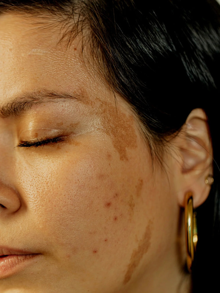 Melasma: qué es, qué tipos existen y por qué vuelve