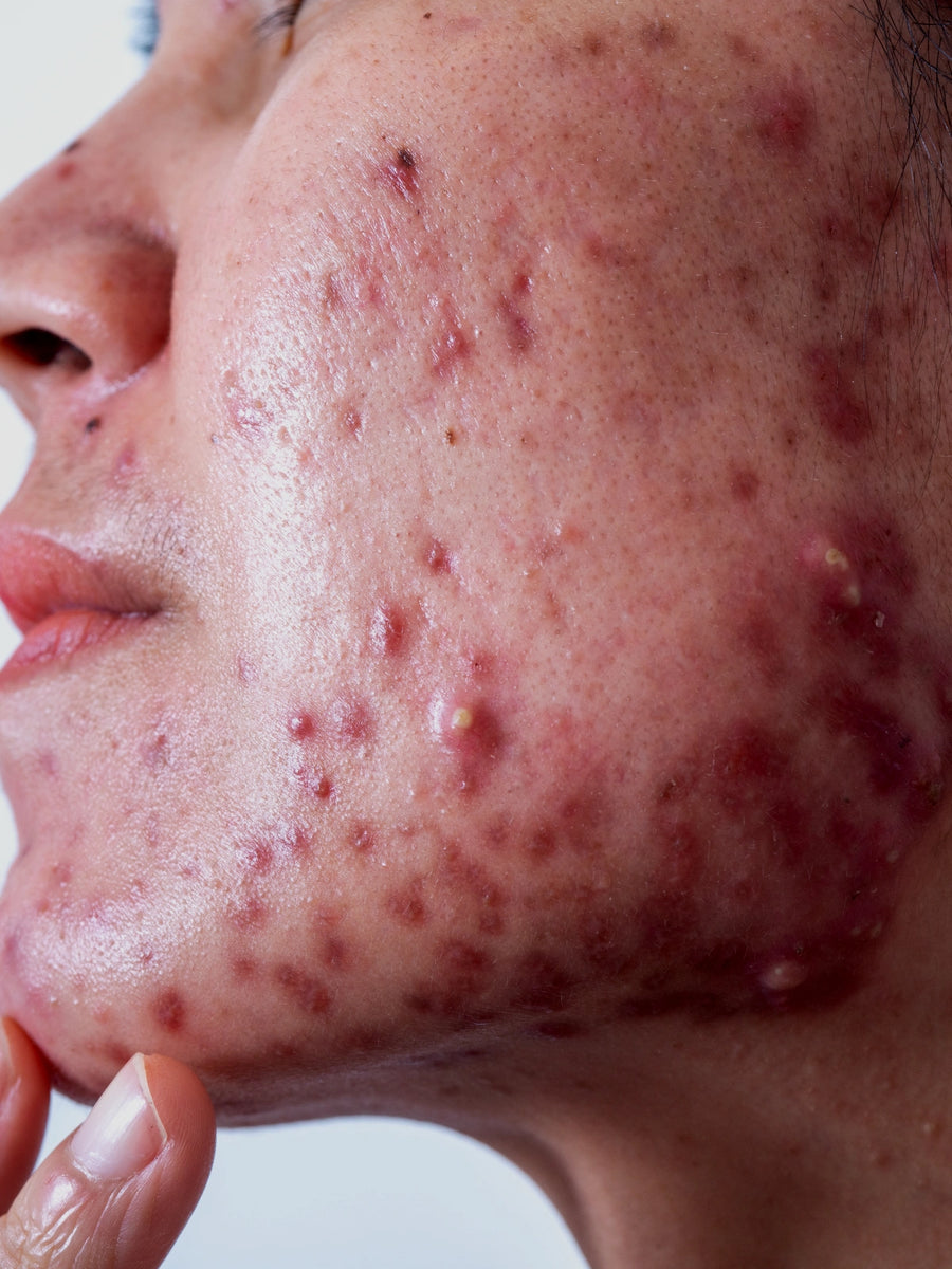 Piel del rostro con acné activo inflamado, imagen ilustrativa para diferenciarlo de las cicatrices de acné