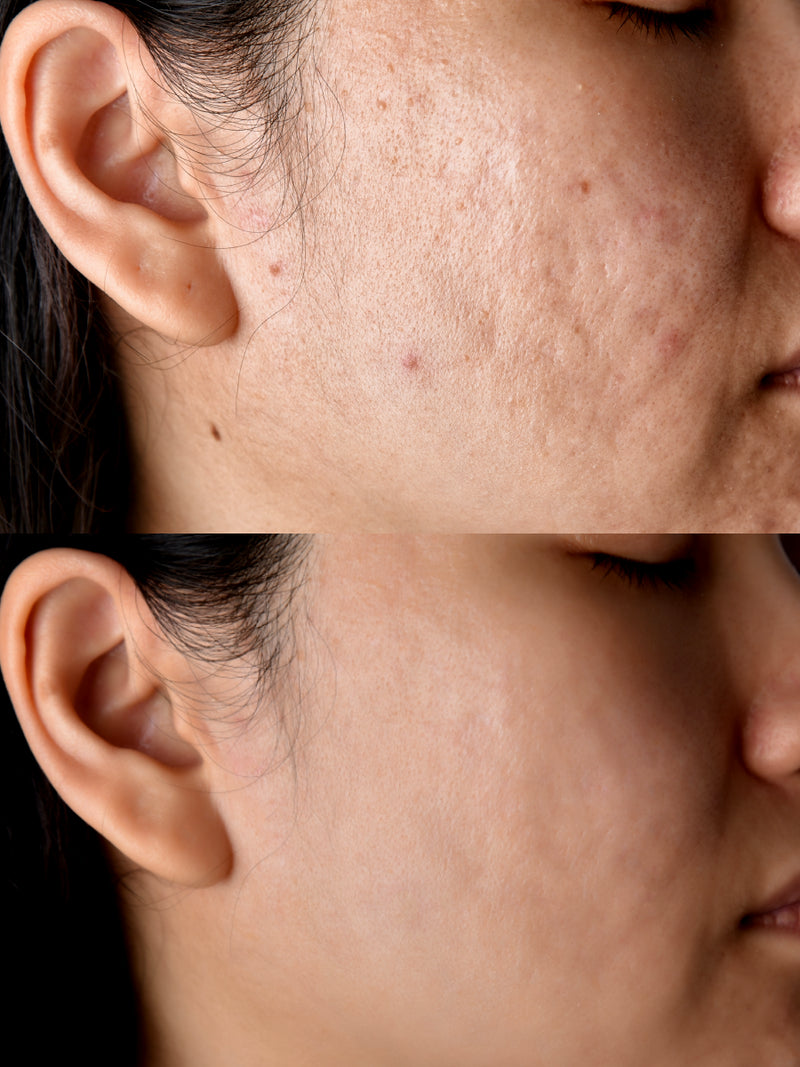 Cicatrices de acné · láser CO2 + SkinPen®
