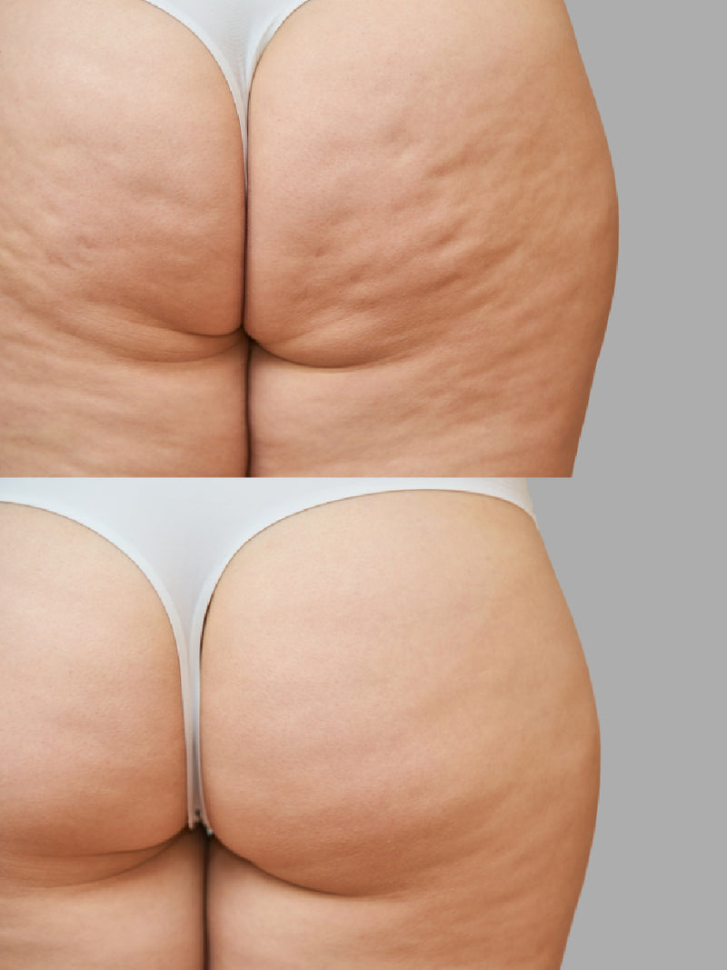 Estrías · láser CO2 + SkinPen®