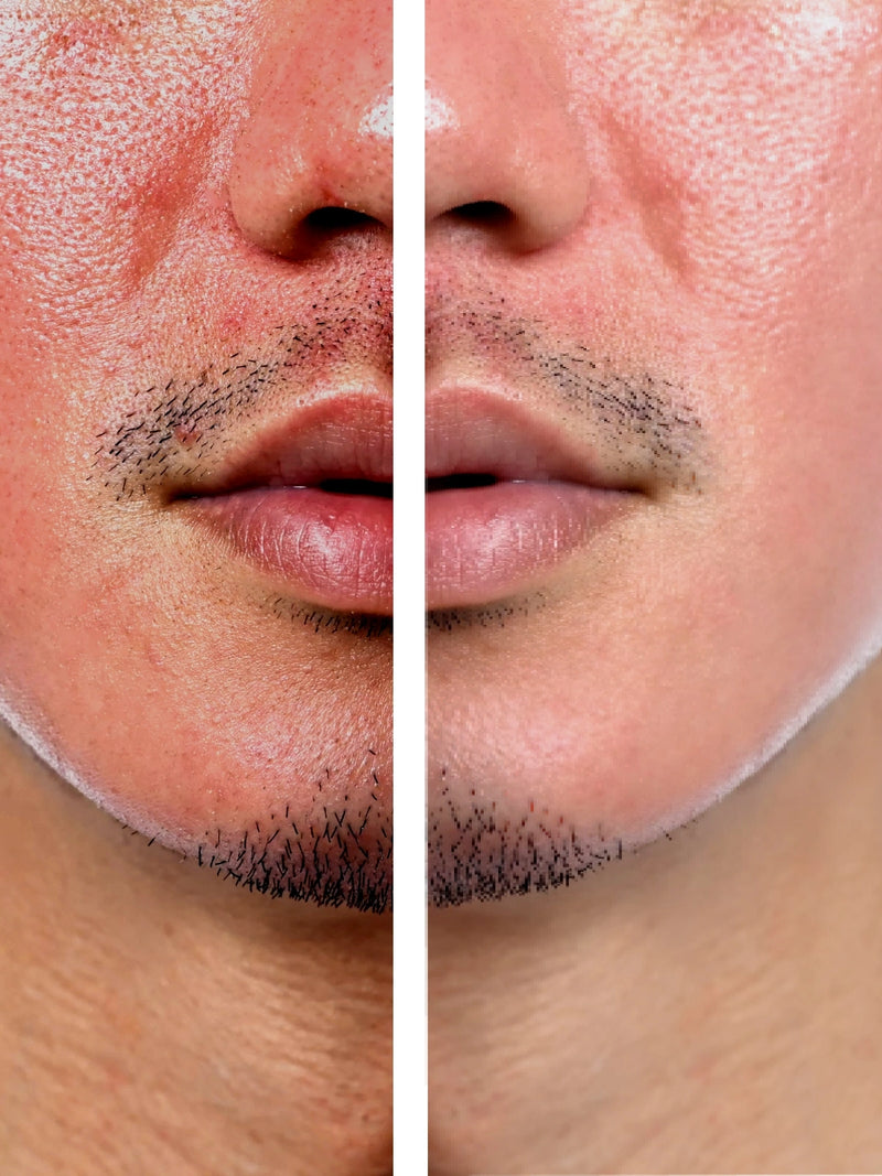 Rosacea · at the end of the protocol