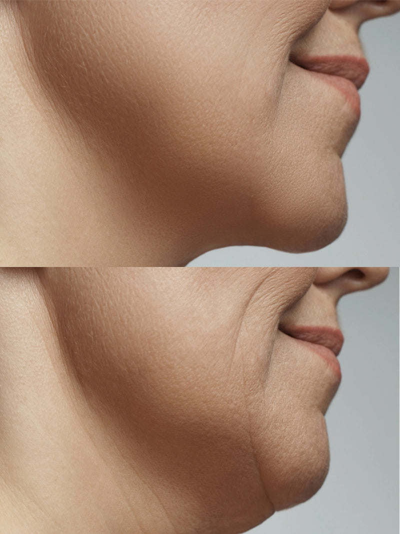 Contorno mandibular · al terminar el protocolo