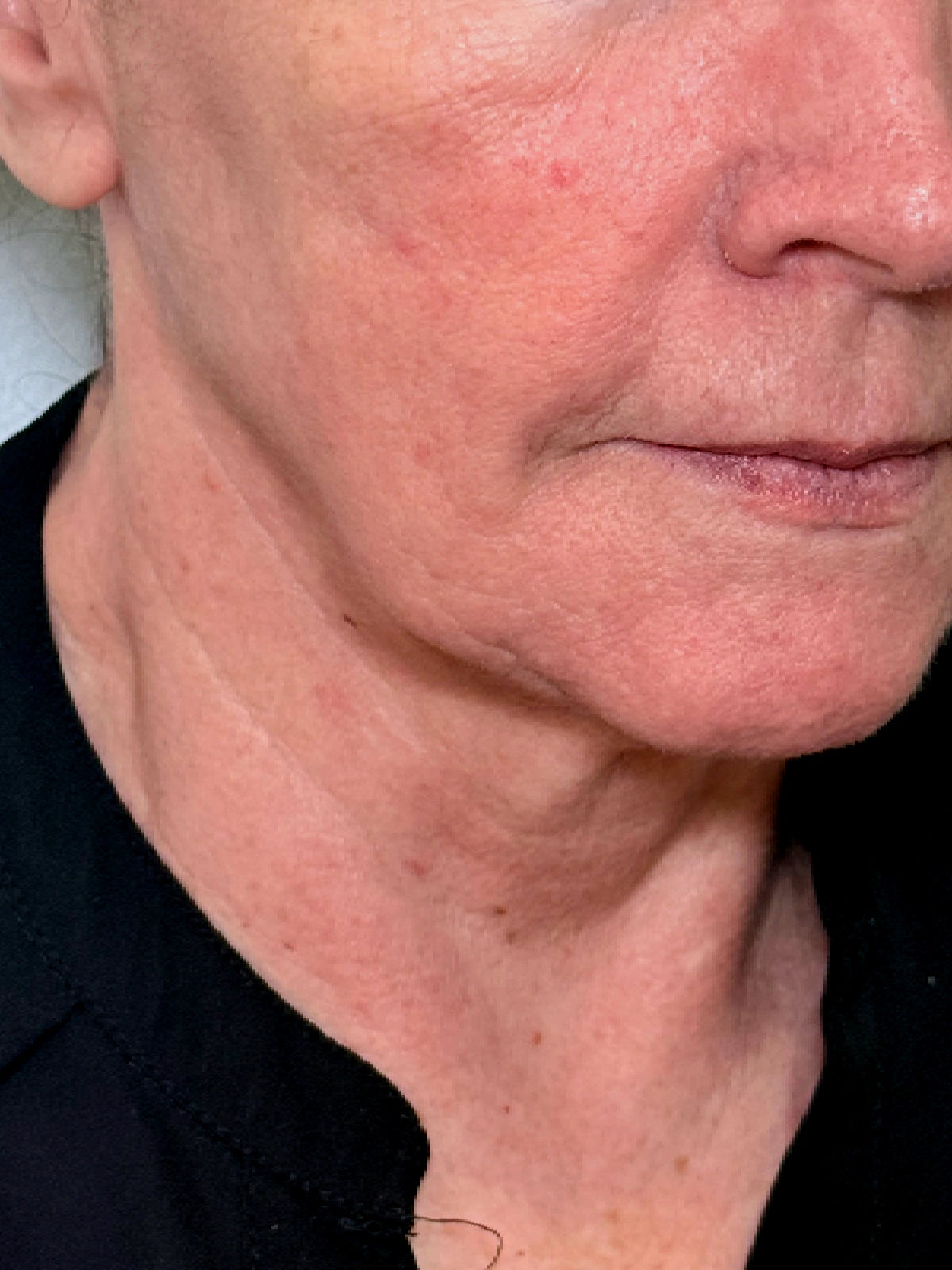 Perfil de una mujer madura con pérdida de definición en el contorno mandibular y el cuello, tratamiento con bioestimuladores de colágeno en Medellín