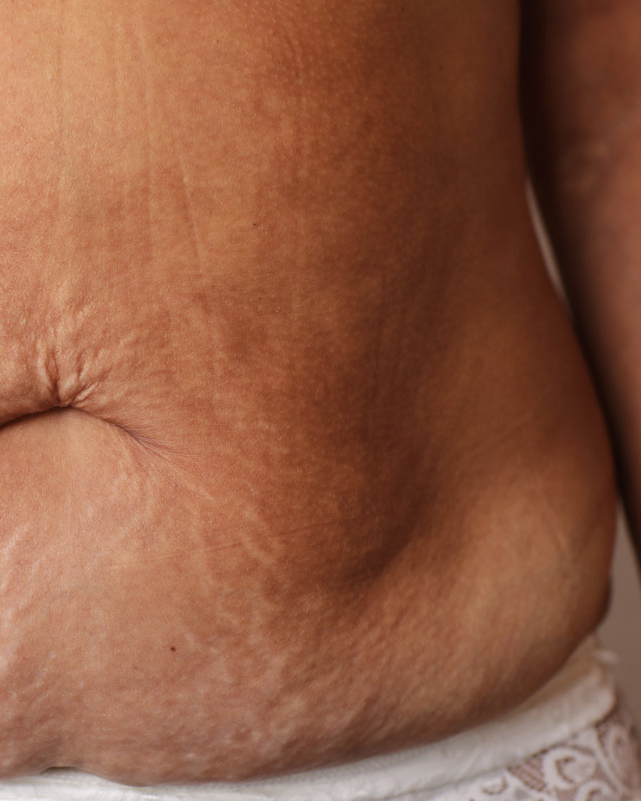 Estrías en la piel del abdomen, tratables con láser CO2 y microneedling SkinPen en El Poblado, Medellín
