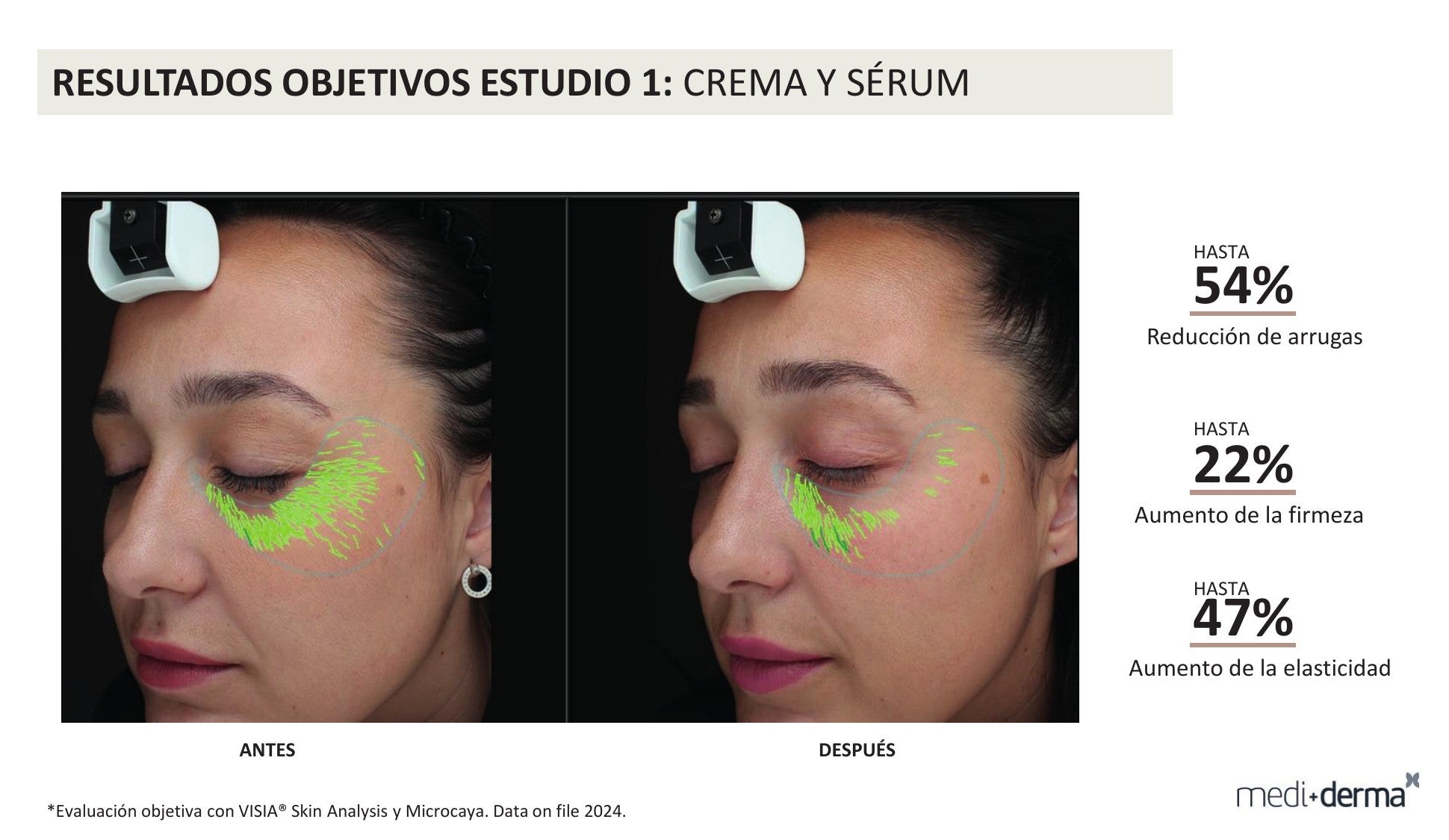 Kit Global Filler Fillderma medi+derma