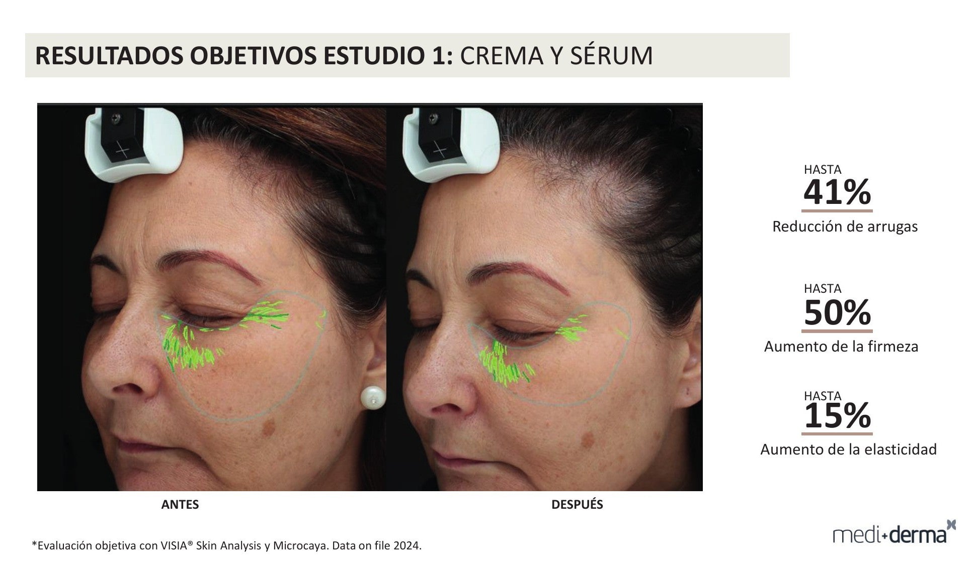 Kit Global Filler Fillderma medi+derma