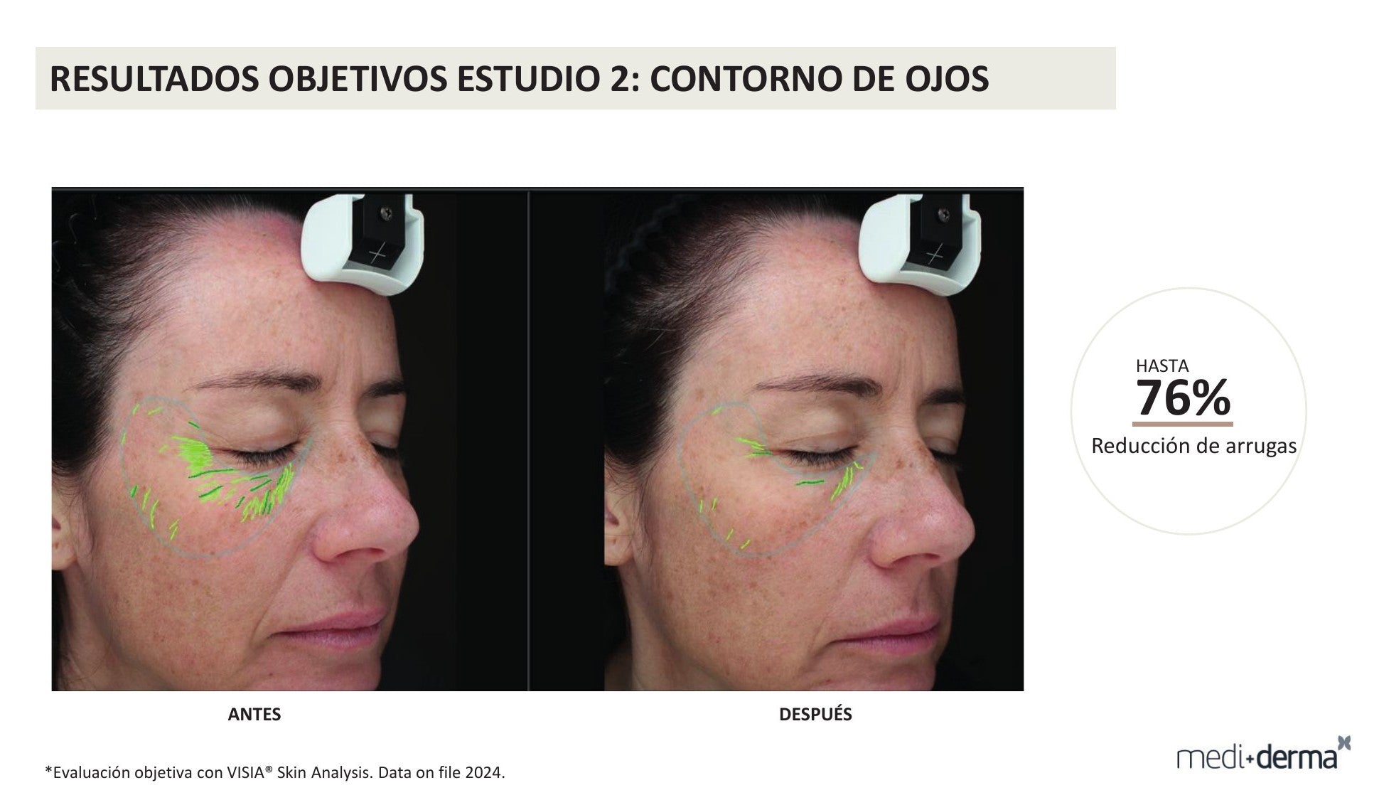 Kit Global Filler Fillderma de medi+derma con crema, sérum, contorno de ojos y neceser