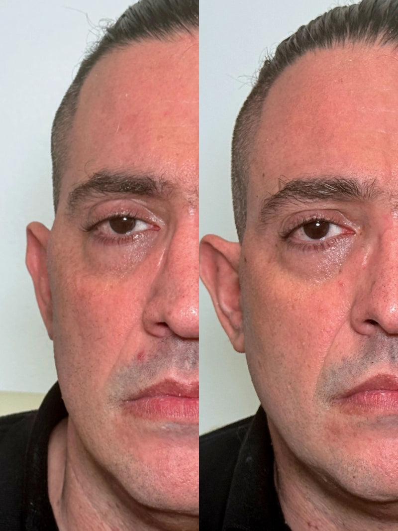 Firmeza facial · al terminar el protocolo