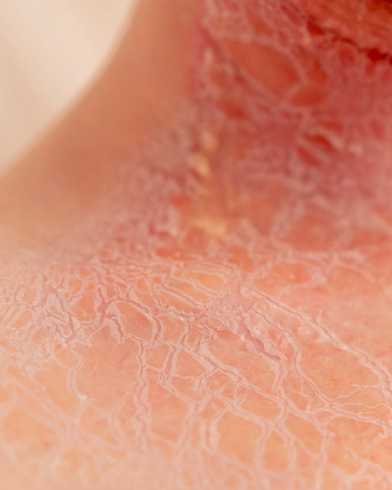 Skin quality (microbotox)