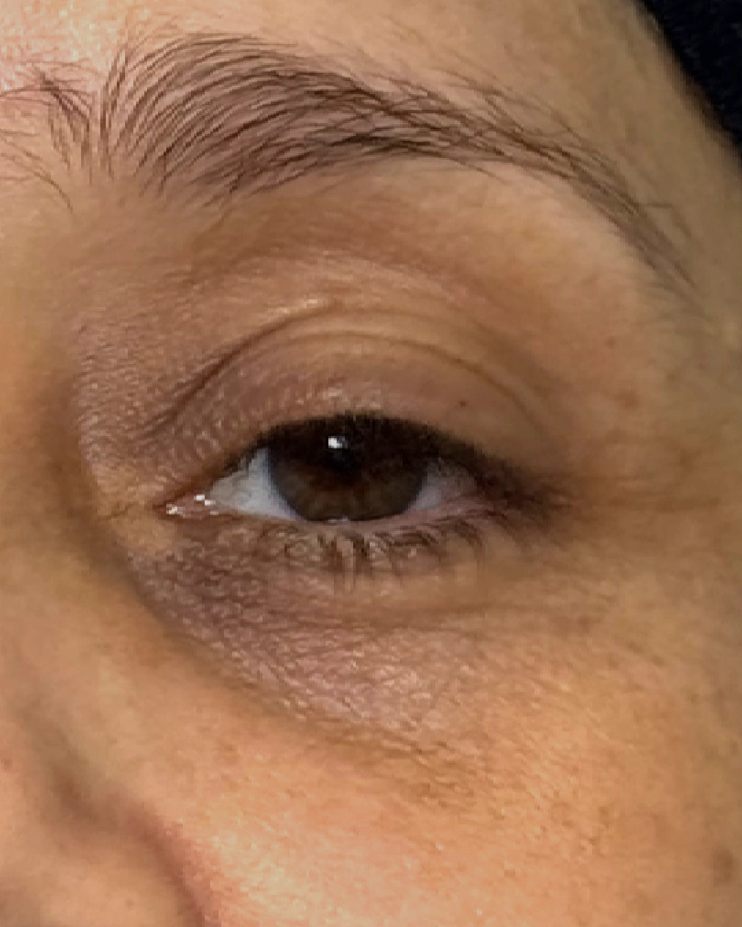 Zona debajo del ojo de una paciente antes del tratamiento de ojeras, consultorio Olga Gómez en Medellín