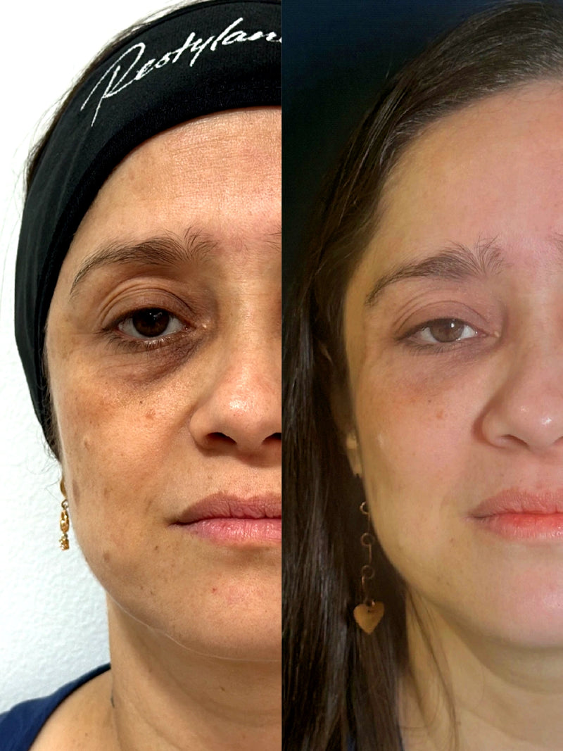 Ojeras mixtas · 15 días después