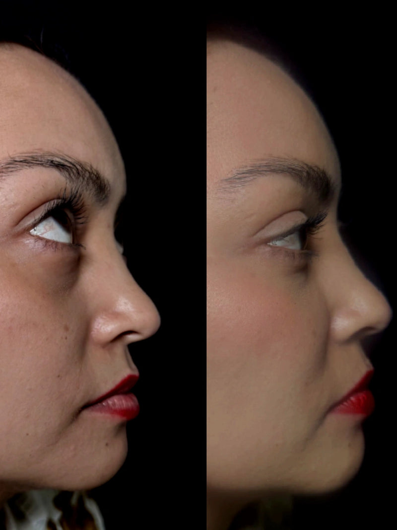 Ojeras hundidas, vista de perfil · al terminar el protocolo