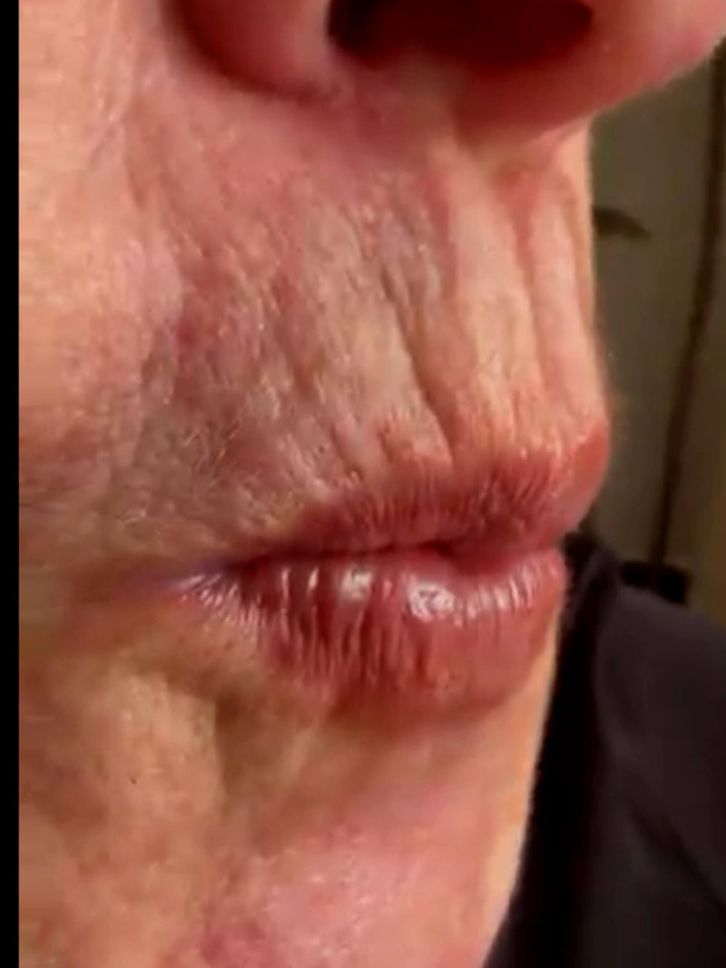 Código de barras (labio superior)
