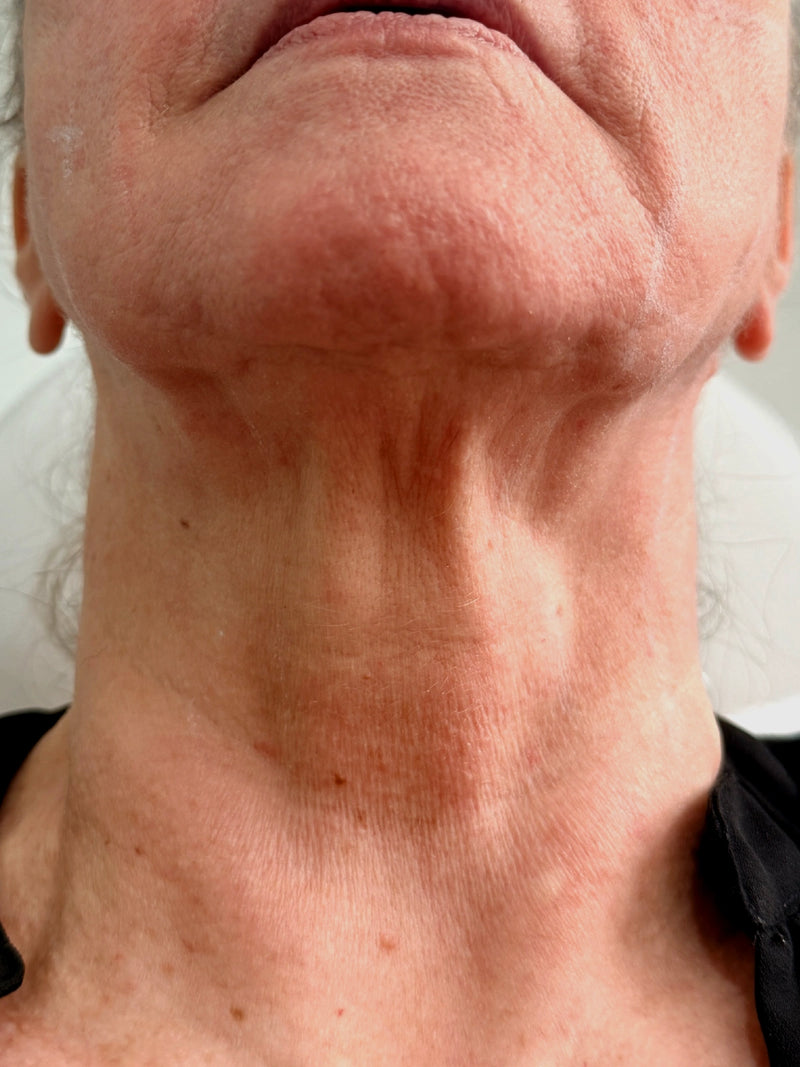 Neck (platysmal bands)