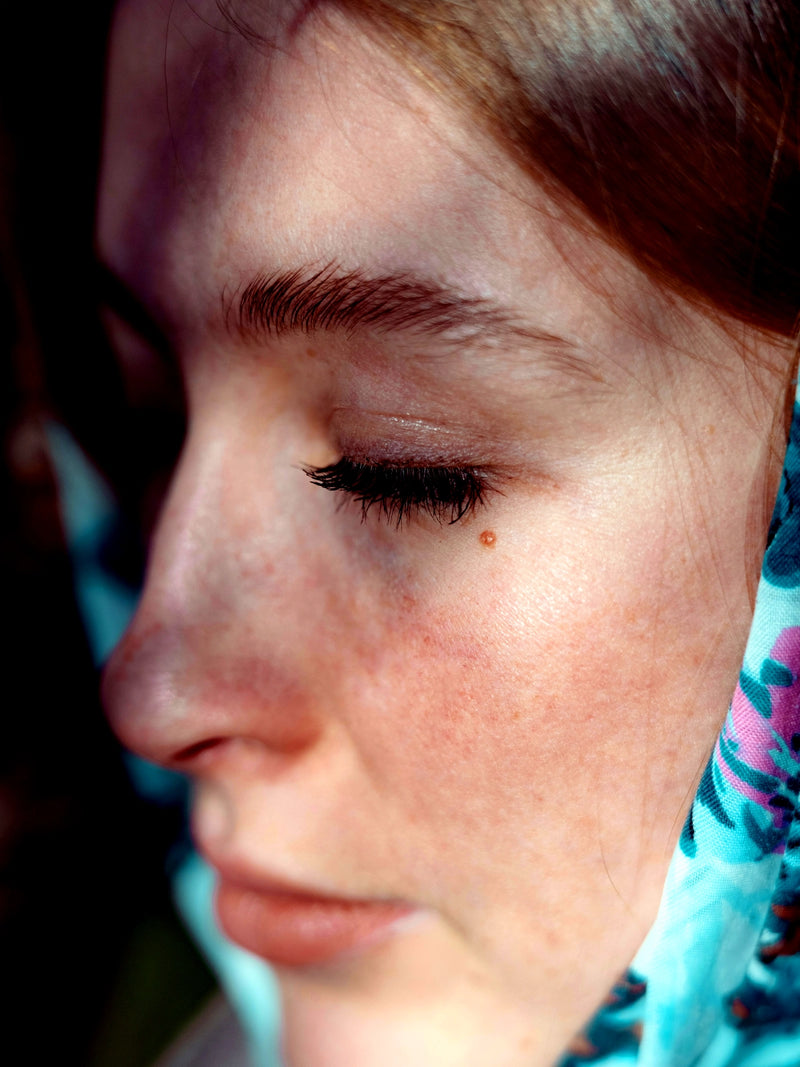 Rosacea (redness and flushing)