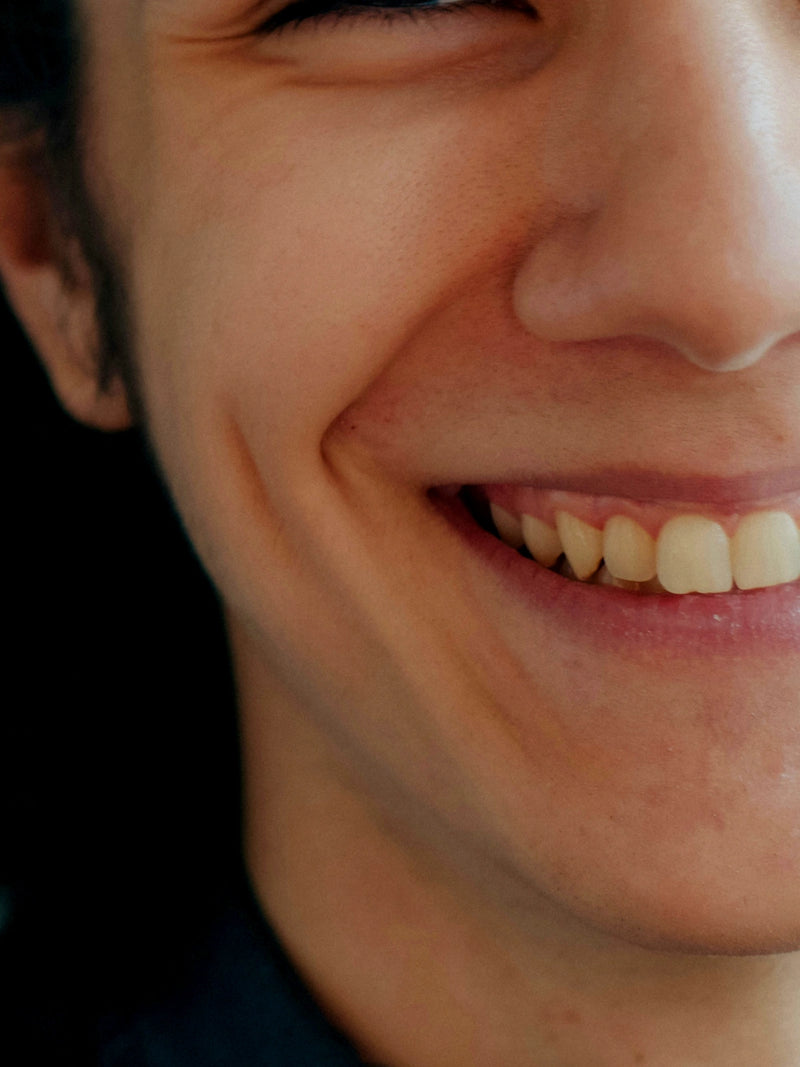Gummy smile